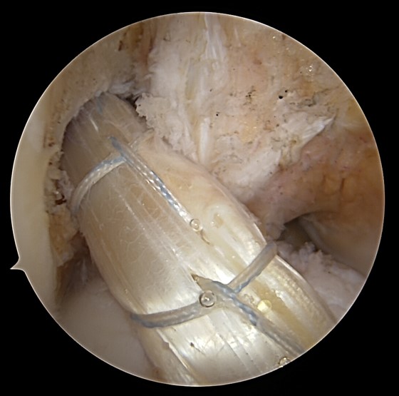 Plastie du Ligament Croisé Antérieur (LCA)